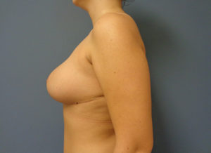 Breast Reduction Before and After Pictures Nashville, TN