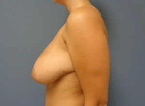 Breast Reduction Before and After Pictures Nashville, TN