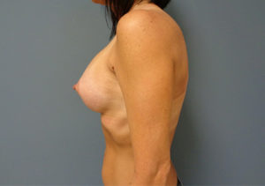 Breast Augmentation Before and After Pictures Nashville, TN