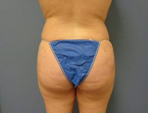 Butt Augmentation Before and After Pictures Nashville, TN