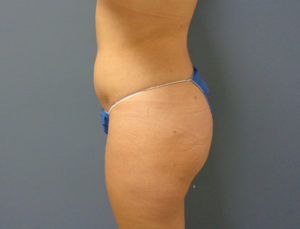 Butt Augmentation Before and After Pictures Nashville, TN