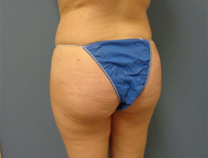 Butt Augmentation Before and After Pictures Nashville, TN