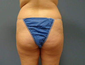 Butt Augmentation Before and After Pictures Nashville, TN