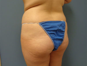 Butt Augmentation Before and After Pictures Nashville, TN