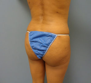 Butt Augmentation Before and After Pictures Nashville, TN