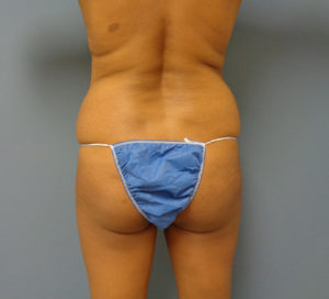 Butt Augmentation Before and After Pictures Nashville, TN