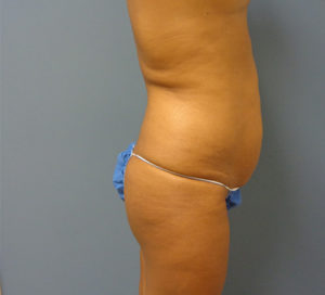 Butt Augmentation Before and After Pictures Nashville, TN