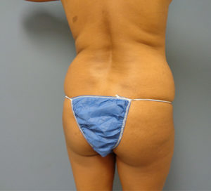 Butt Augmentation Before and After Pictures Nashville, TN