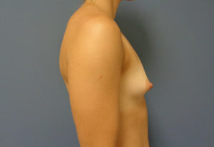 Breast Augmentation Before and After Pictures Nashville, TN