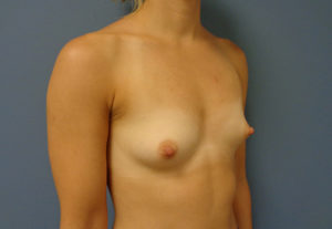 Breast Augmentation Before and After Pictures Nashville, TN