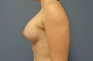 Breast Augmentation Before and After Pictures Nashville, TN