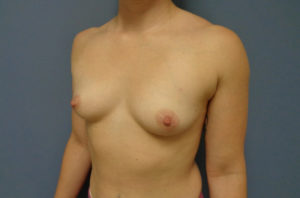 Breast Augmentation Before and After Pictures Nashville, TN