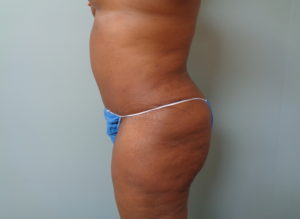 Tummy Tuck Before and After Pictures Nashville, TN