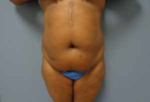 Tummy Tuck Before and After Pictures Nashville, TN