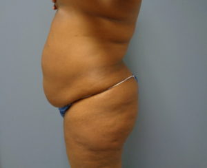 Tummy Tuck Before and After Pictures Nashville, TN