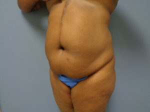 Tummy Tuck Before and After Pictures Nashville, TN