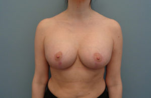 Breast Augmentation with Lift Before and After Pictures Nashville, TN