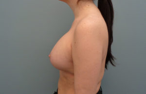 Breast Augmentation with Lift Before and After Pictures Nashville, TN