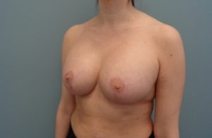 Breast Augmentation with Lift Before and After Pictures Nashville, TN