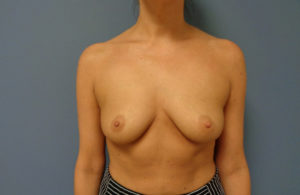 Breast Augmentation with Lift Before and After Pictures Nashville, TN