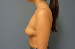 Breast Augmentation with Lift Before and After Pictures Nashville, TN