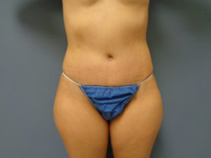 Tummy Tuck Before and After Pictures Nashville, TN