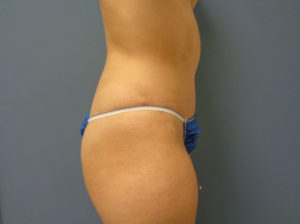 Tummy Tuck Before and After Pictures Nashville, TN