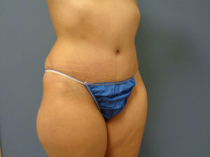 Tummy Tuck Before and After Pictures Nashville, TN