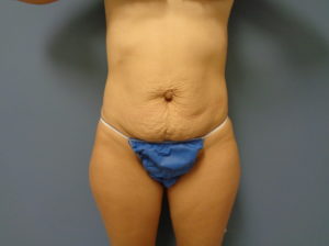 Tummy Tuck Before and After Pictures Nashville, TN