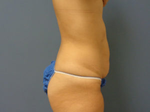 Tummy Tuck Before and After Pictures Nashville, TN