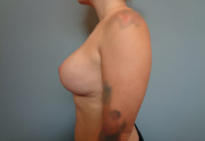 Breast Augmentation with Lift Before and After Pictures Nashville, TN