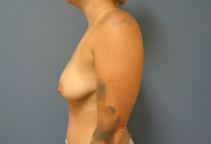 Breast Augmentation with Lift Before and After Pictures Nashville, TN