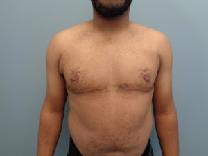 Gynecomastia Before and After Pictures Nashville, TN