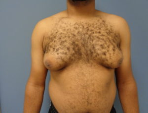 Gynecomastia Before and After Pictures Nashville, TN