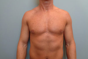 Gynecomastia Before and After Pictures Nashville, TN