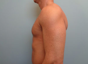 Gynecomastia Before and After Pictures Nashville, TN