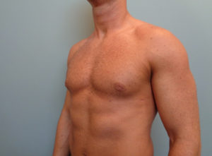 Gynecomastia Before and After Pictures Nashville, TN