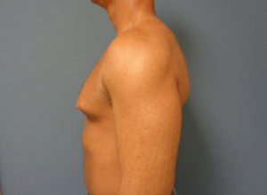 Gynecomastia Before and After Pictures Nashville, TN