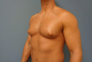 Gynecomastia Before and After Pictures Nashville, TN