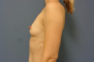 Breast Augmentation Before and After Pictures Nashville, TN