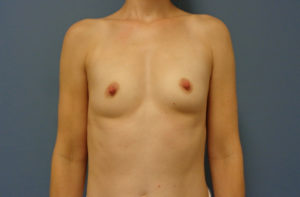Breast Augmentation Before and After Pictures Nashville, TN