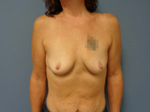 Breast Reconstruction-Implant Based Before & After Pictures in Nashville, TN