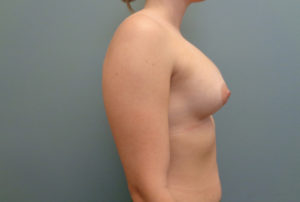 Breast Augmentation Before & After Pictures in Nashville, TN