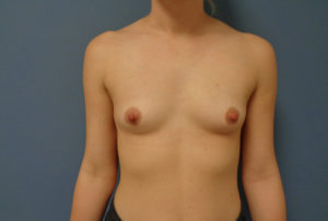 Before & After Pictures in Nashville, TN
