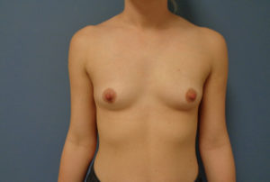 Breast Augmentation Before & After Pictures in Nashville, TN