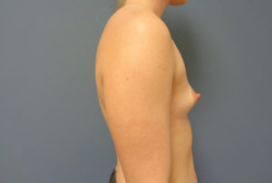 Breast Augmentation Before & After Pictures in Nashville, TN