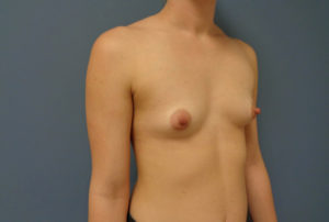 Breast Augmentation Before & After Pictures in Nashville, TN