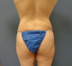 Tummy Tuck with Lift Before & After Pictures in Nashville, TN