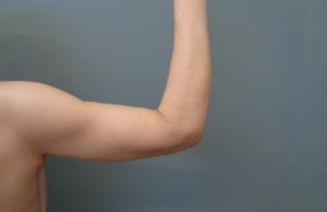 Arm Lift Before & After Pictures in Nashville, TN