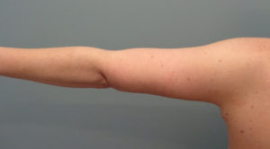 Arm Lift Before & After Pictures in Nashville, TN